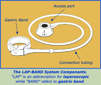 lap band
