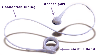 Lap Band Surgery