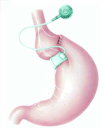Lap Band Surgery Process