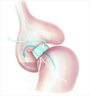 Lap Band Around the Stomach
