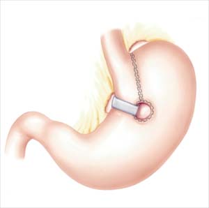 Vertical Banded Gastroplasty